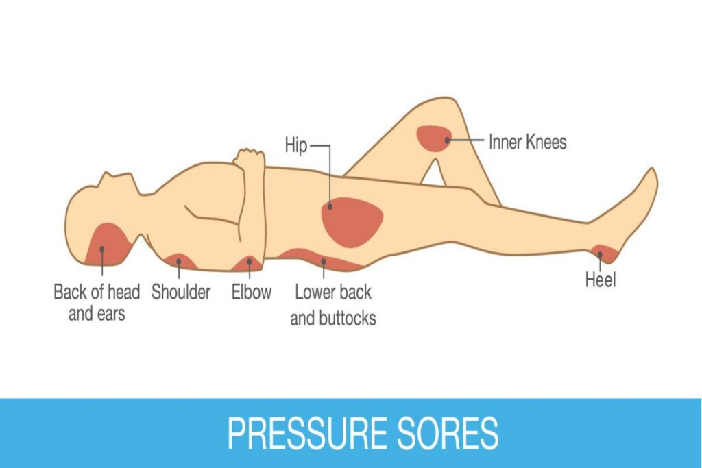 What to Do if Your Loved One Develops a Pressure Injury in a Nursing Home