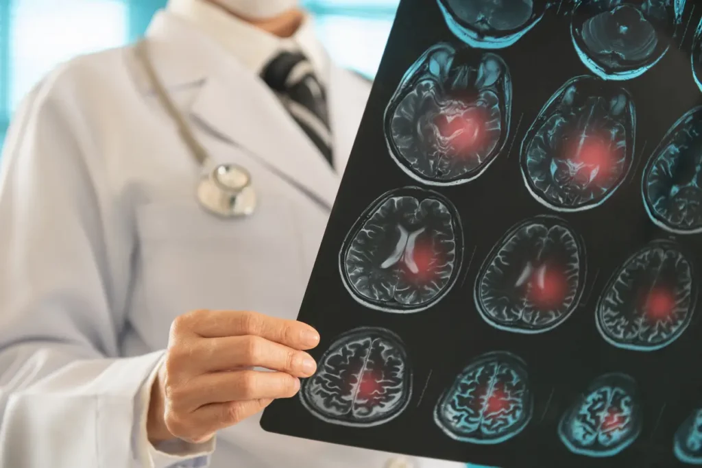 stroke malpractice